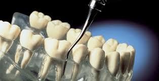 parodontológia, fogágybetegség, fogtartó szerkezet, foglazulás