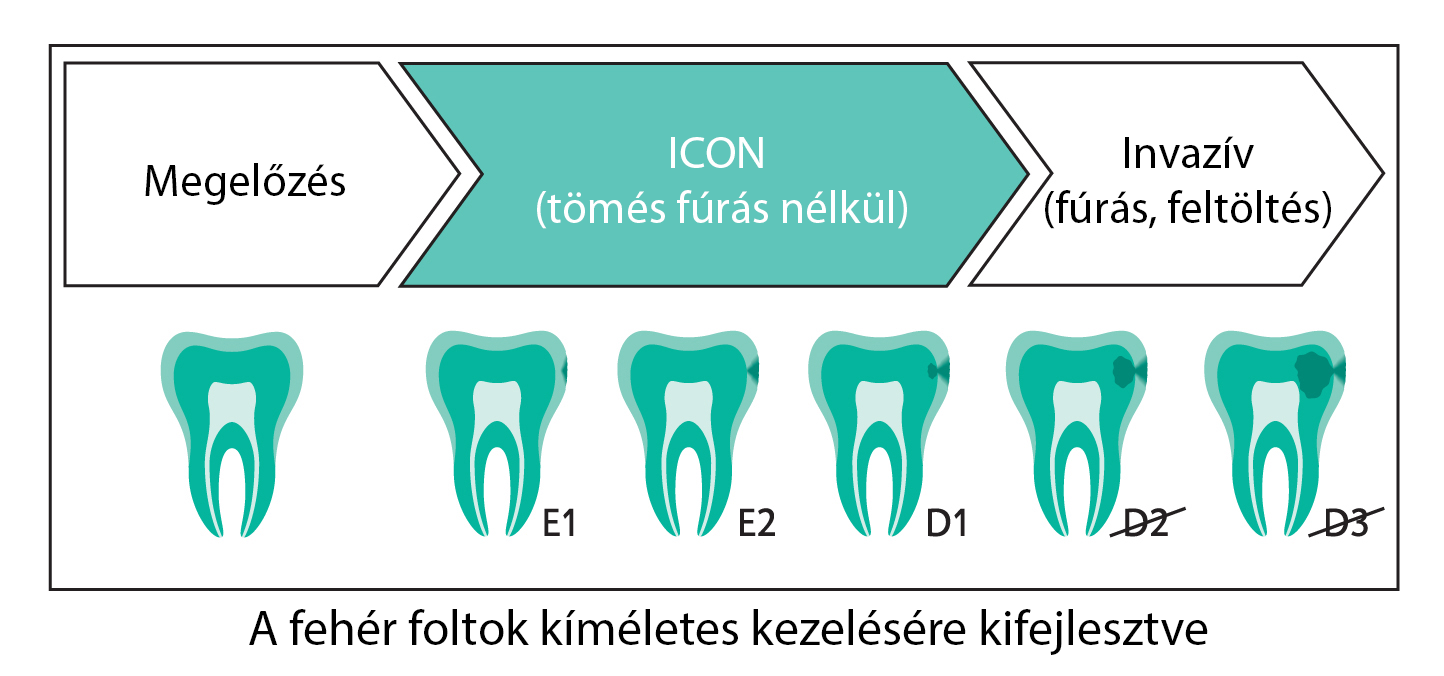 torokugrato-dental-furas-nelkuli-kezeles-icon-fogtomes-folyamat