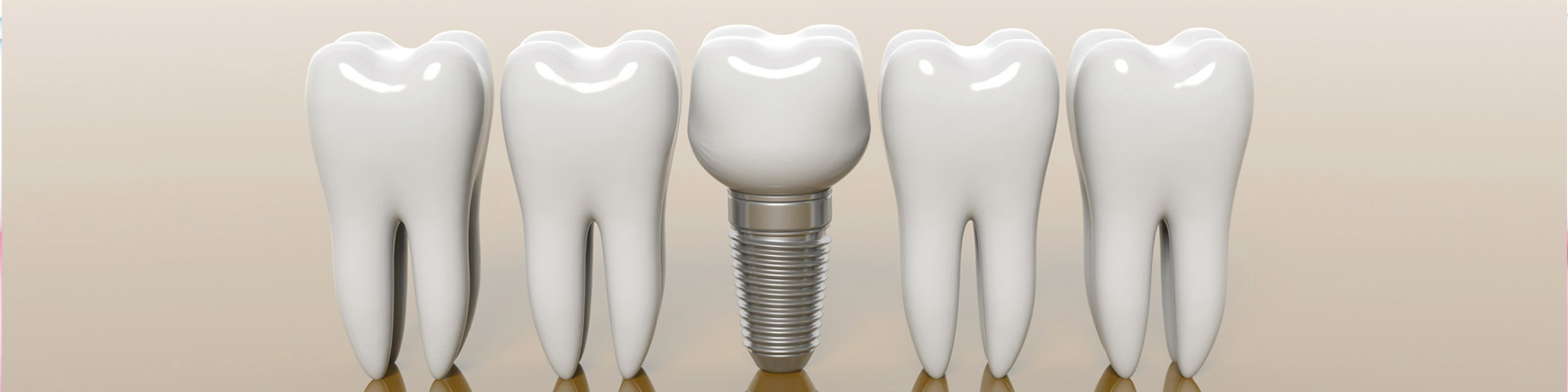 torokugrato-dental-budaors-fogbeultetes-fogimplantatum