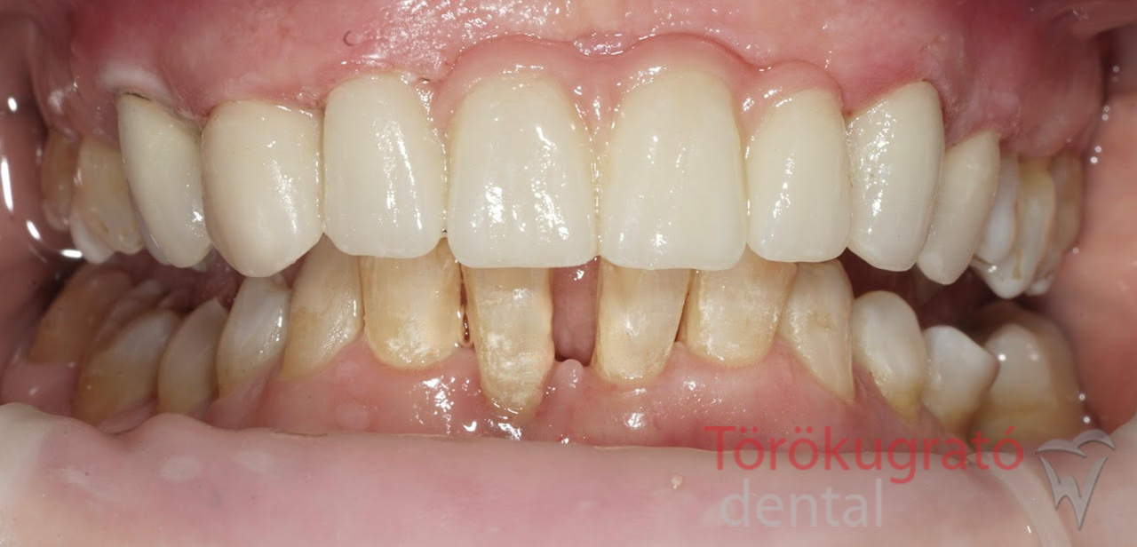 torokugrato-dental-fogaszat-fogpotlas-budaors-utan