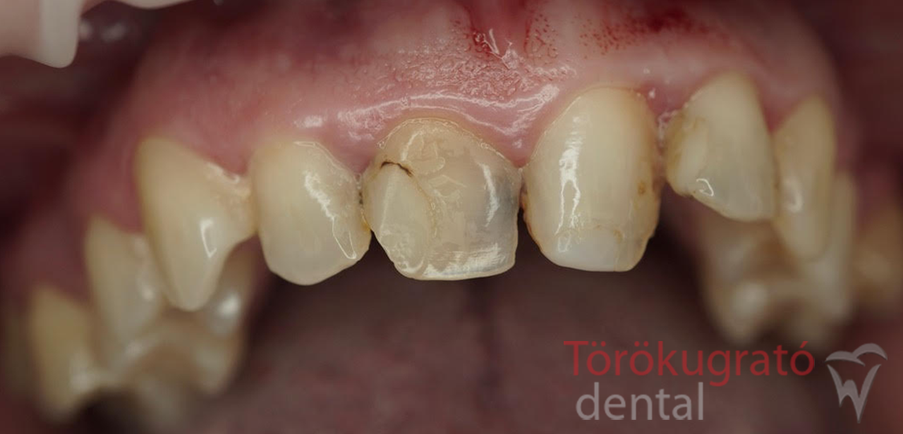 torokugrato-dental-fogaszat-fogpotlas-budaors-elotte