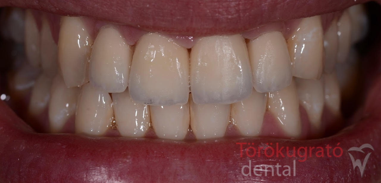 torokugrato-dental-fogaszat-fogpotlas-budaors-utana