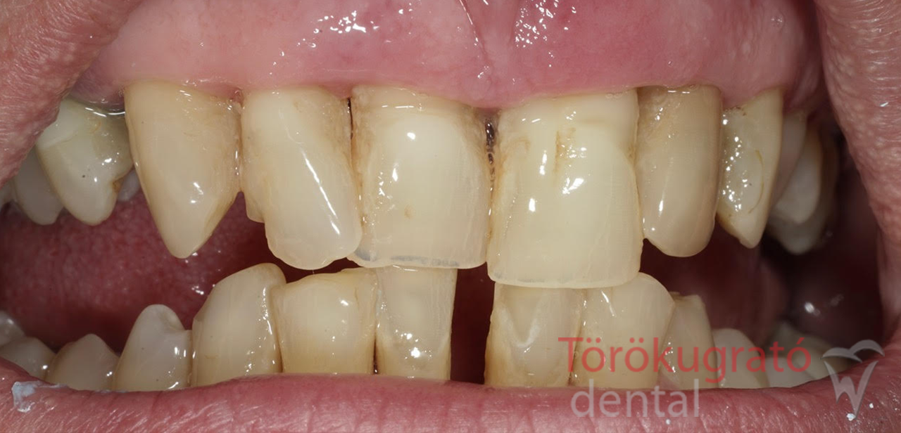 torokugrato-dental-fogaszat-fogpotlas-budaors-elott