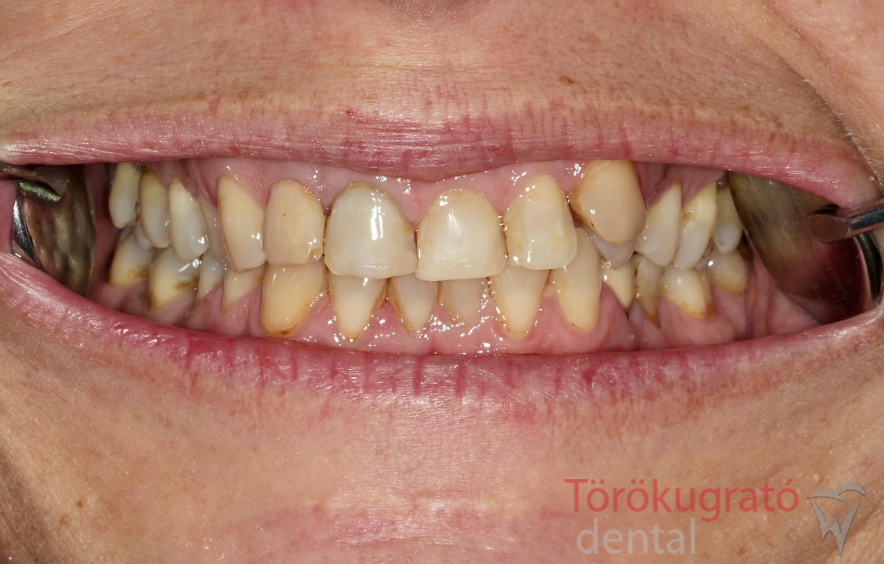 torokugrato-dental-fogaszat-fogpotlas-elotte