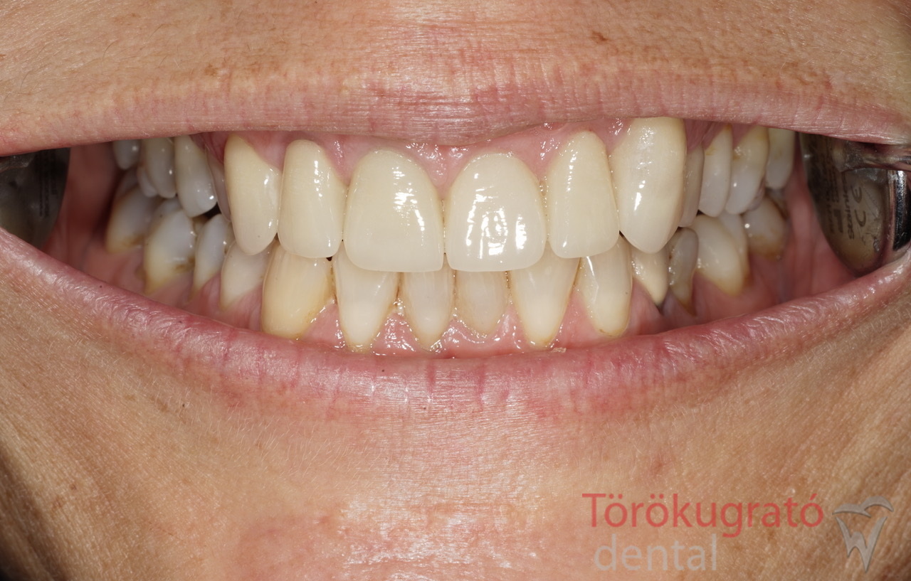 torokugrato-dental-fogaszat-fogpotlas-utana