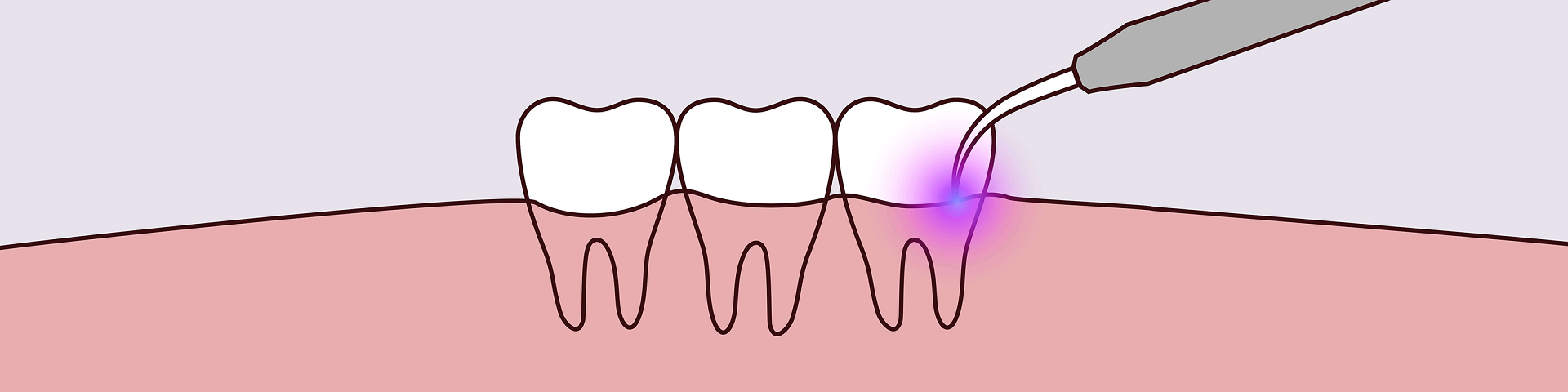 torokugrato-dental-budaors-fogaszat-Lezer-kezelesek-oldal-banner-felul