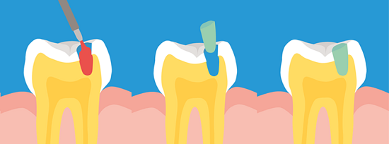 torokugrato-dental--carisolv-tomes-furas-nelkuli-kezeles-masodik-lepes